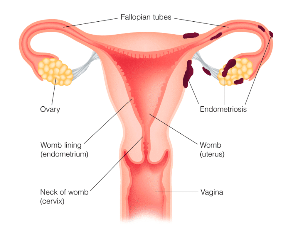 Troubles hormonaux : des Règles douloureuses à l'Endométriose