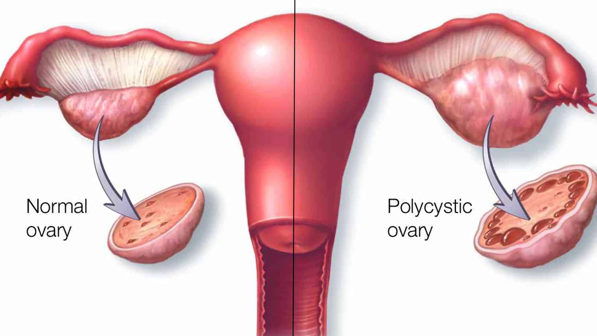 Syndrome polykystique ovarien SOPK : symptômes et prise en charge - Physio  Sahifa