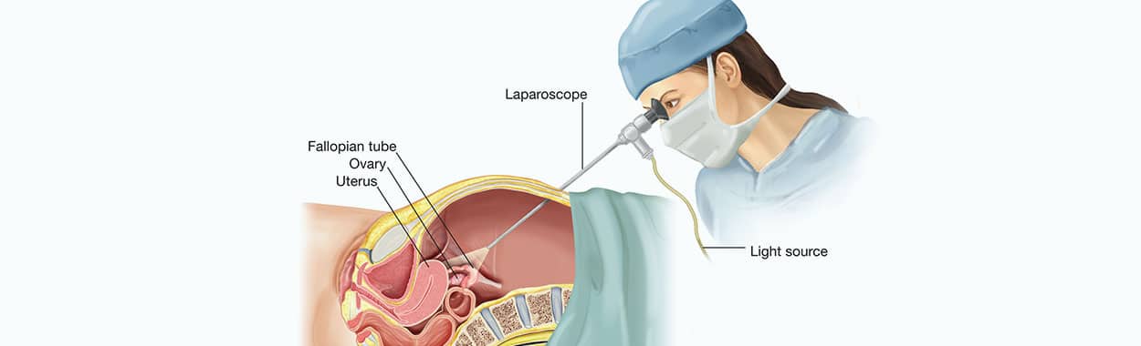 Chirurgie laparoscopique de FIV - IVF Turquie