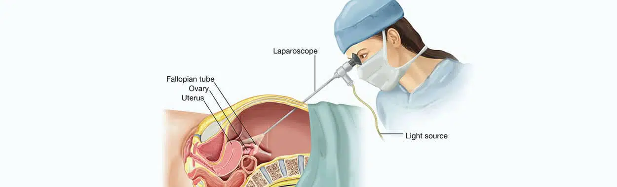 Laparotomia e Laparoscopia