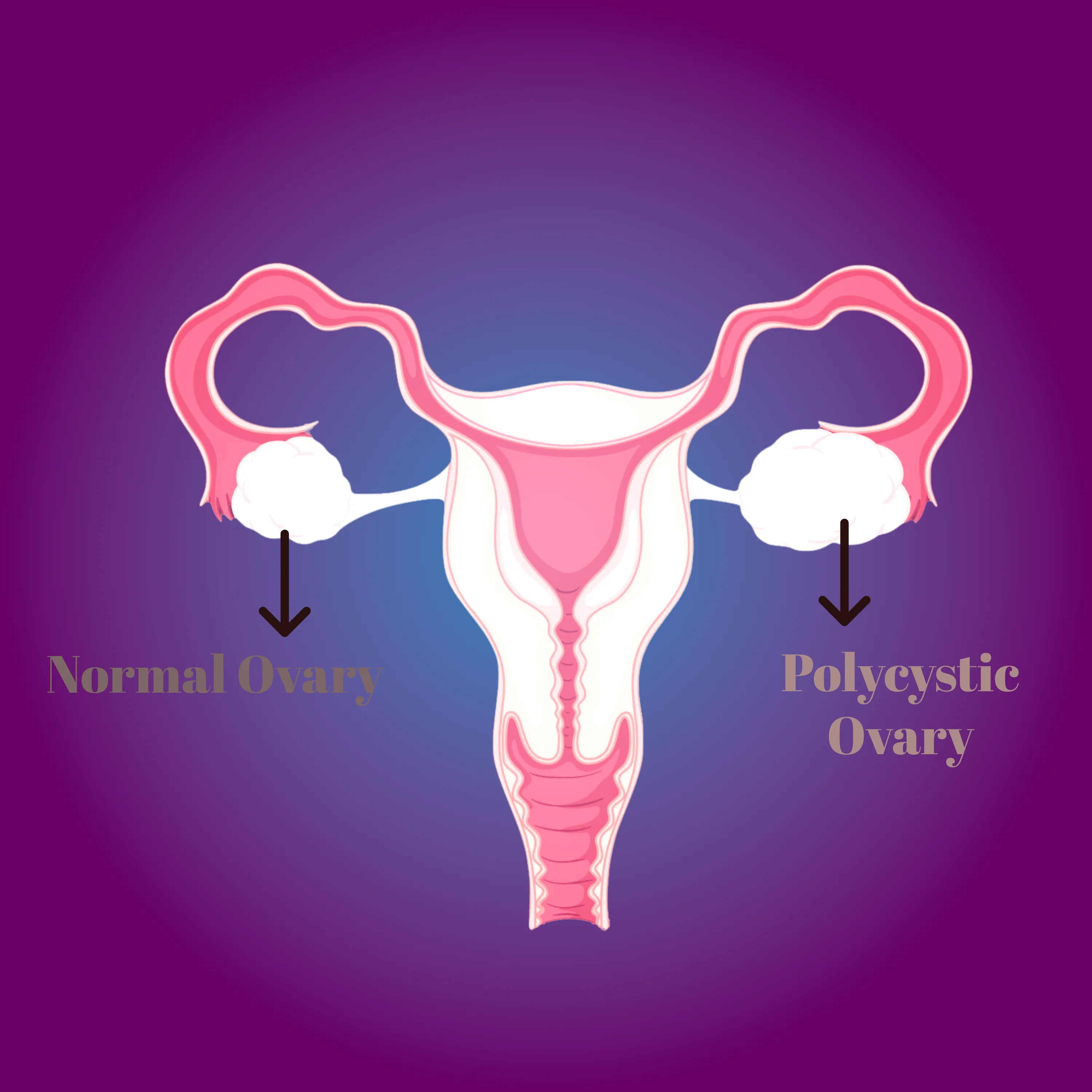 Getting Pregnant With PCOS