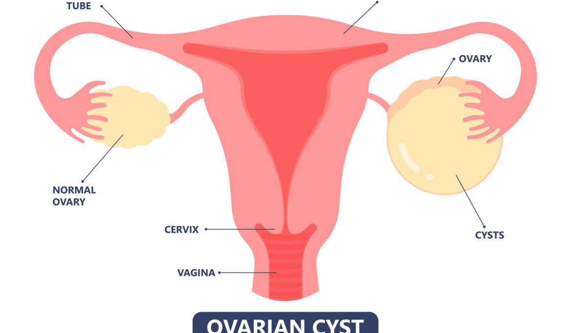 Understanding Ovarian Cysts: Symptoms, Causes, and Treatments