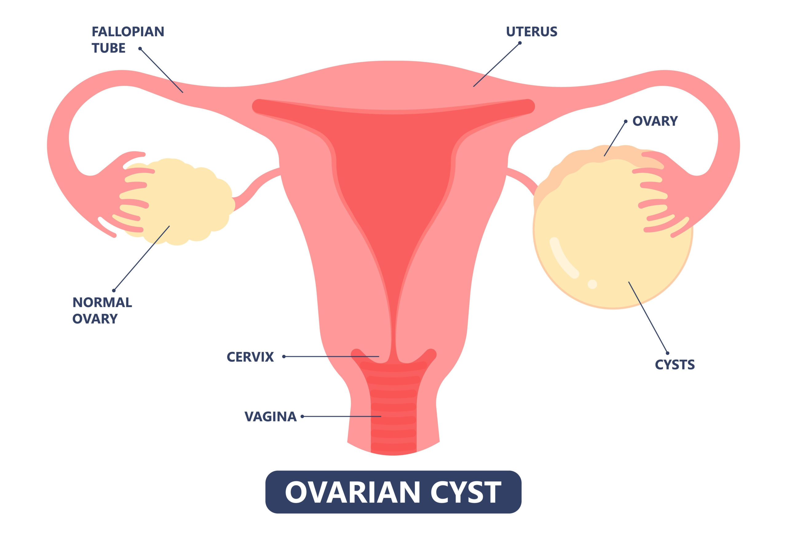 Tout ce que vous devez savoir sur les kystes ovariens : causes ...