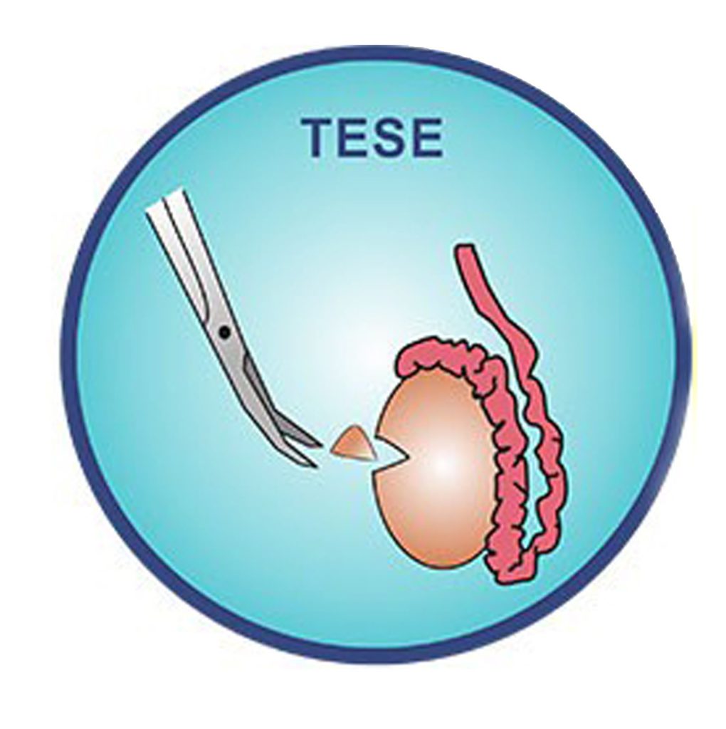 Understanding TESE: A Guide to Treating Male Infertility