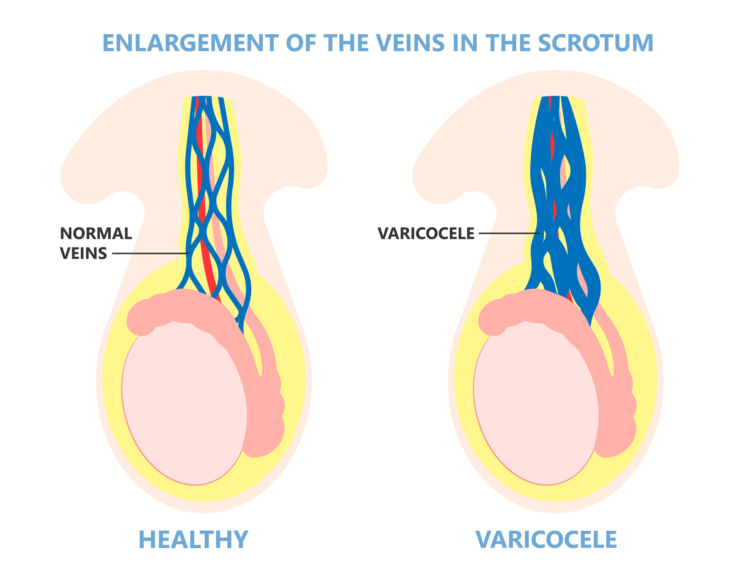 Varicocele Treatment Without Surgery