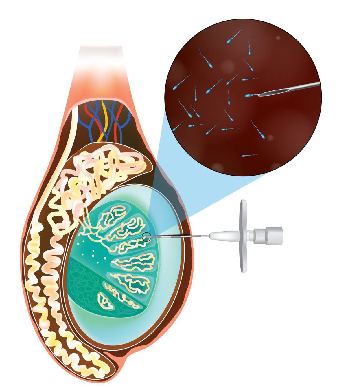 Testicular Sperm Aspiration (TESA): A Guide for Overcoming Male Infertility