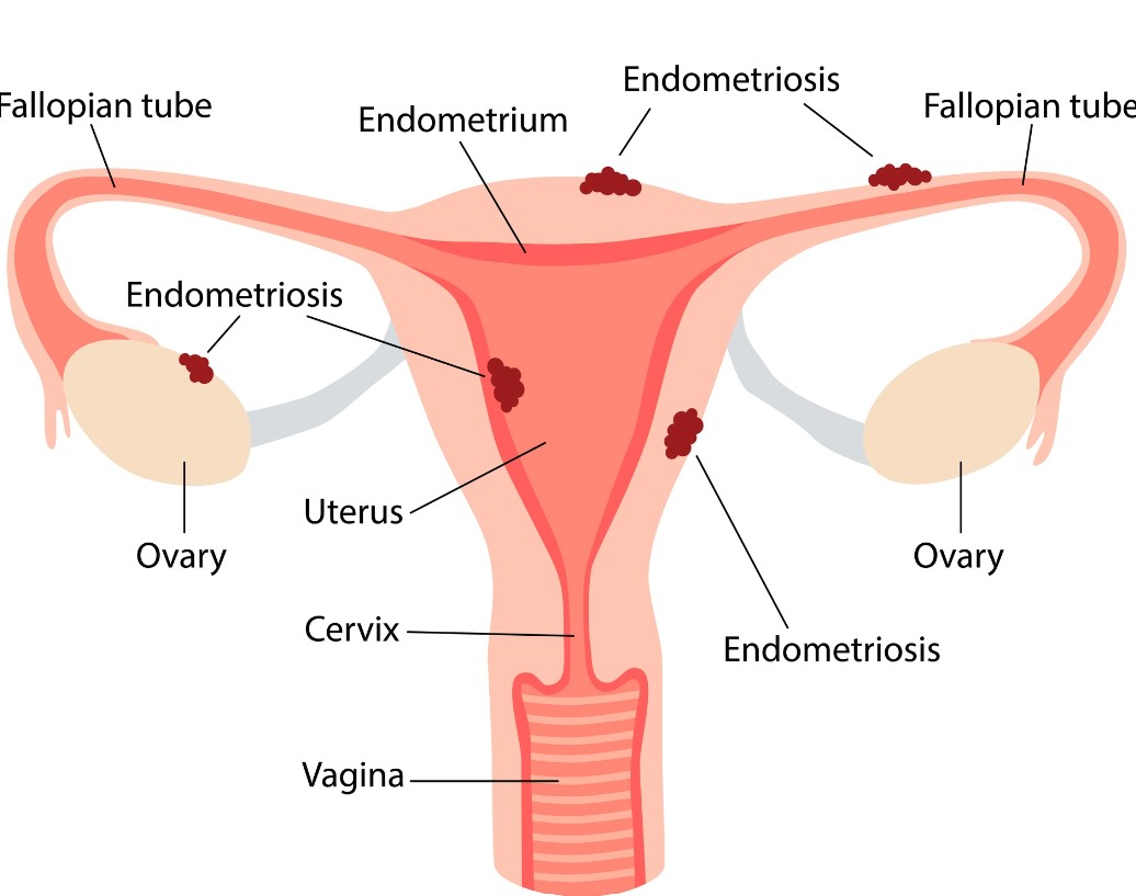 Understanding Endometriosis: Symptoms, Causes, and Treatments